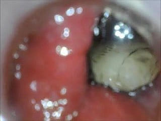anal endoscope pain in the neck comport oneself alien medial